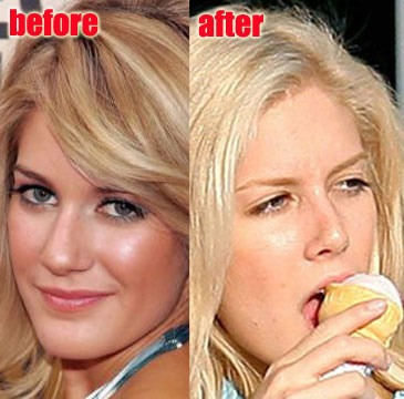 heidi montag before and after. Heidi Montag Plastic Surgery