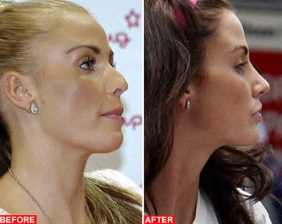 Nose Plastic Surgery Cost on Katie Price Plastic Surgery